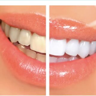 Two people Smile whiter Treatment