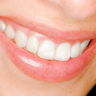 1 hour smile whiter Treatment